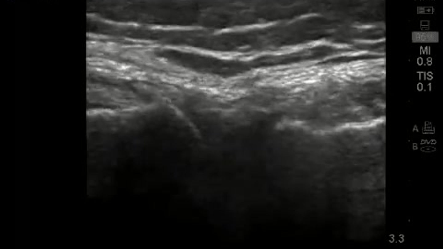 Dr Steven Sampson demonstrates ultrasound exam of the Lateral Meniscus